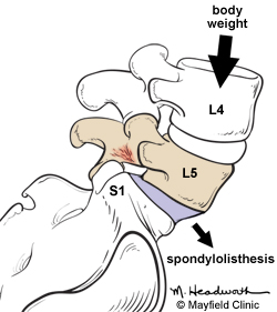 Spondiloza este alunecarea in fata a unei vertebre din pozitia sa normala cauzata de spondiloliza